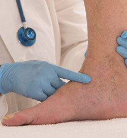 Doctor checking the patient varicose veins in leg at Phoenix, AZ