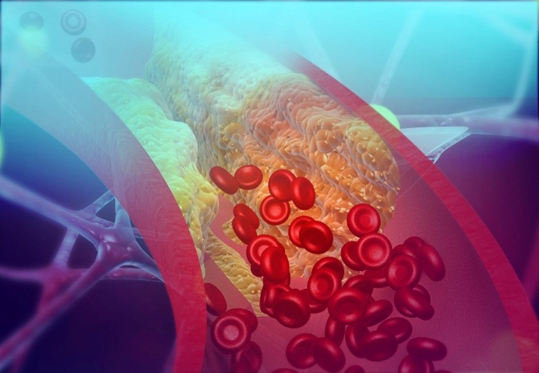 Illustration of red blood cells flowing through an artery that is clogged by Arizona Vein & Laser Institute