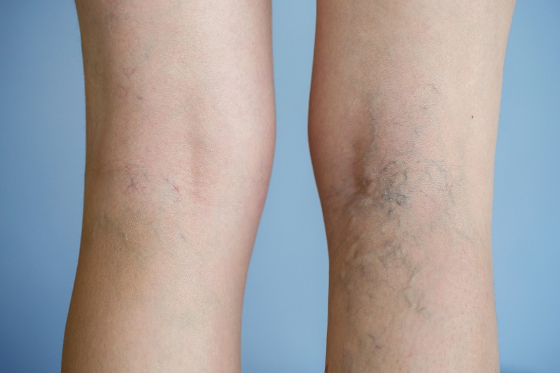 The back of knees with varicose veins  by Arizona Vein & Laser Institute