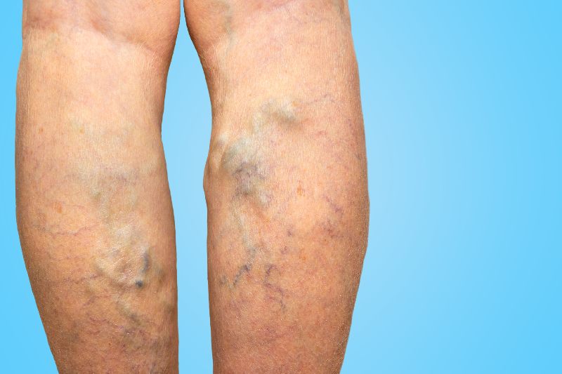 Varicose veins on legs by Arizona Vein & Laser Institute